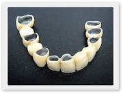 Металлокерамическая коронка