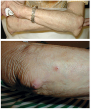 Боли в суставах,  как причина разновидности артрита