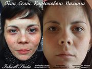 Карбоновый Пилинг