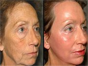 Как убрать морщины. Микрокрем против морщин.  Instantly Ageless.