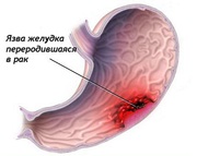 Рак желудка. Лечение.