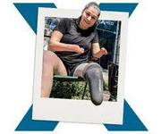 Luxmed - Get Above Knee Prosthetic Leg in Russia